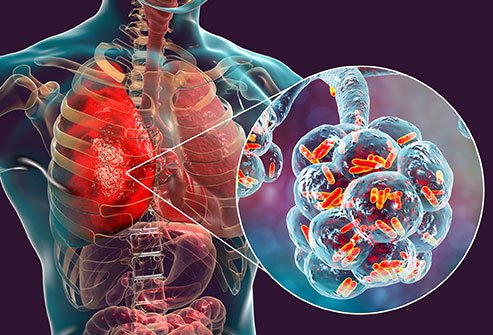 Pneumonia
