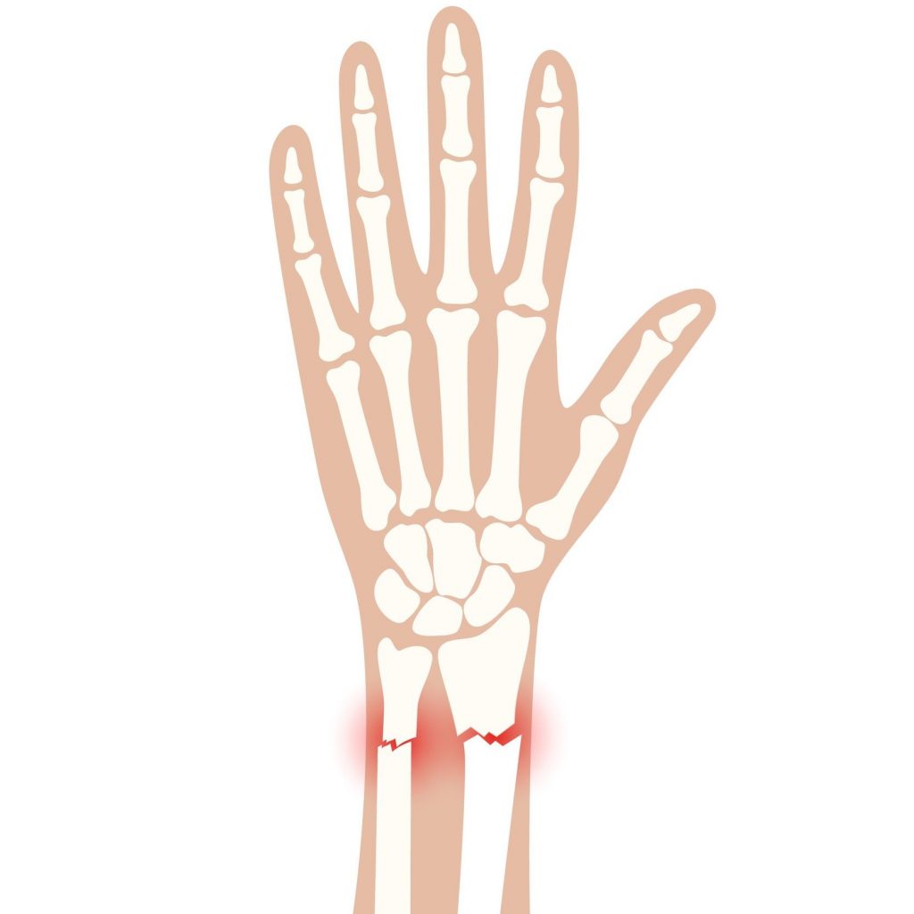 Radius & Ulna Fracture