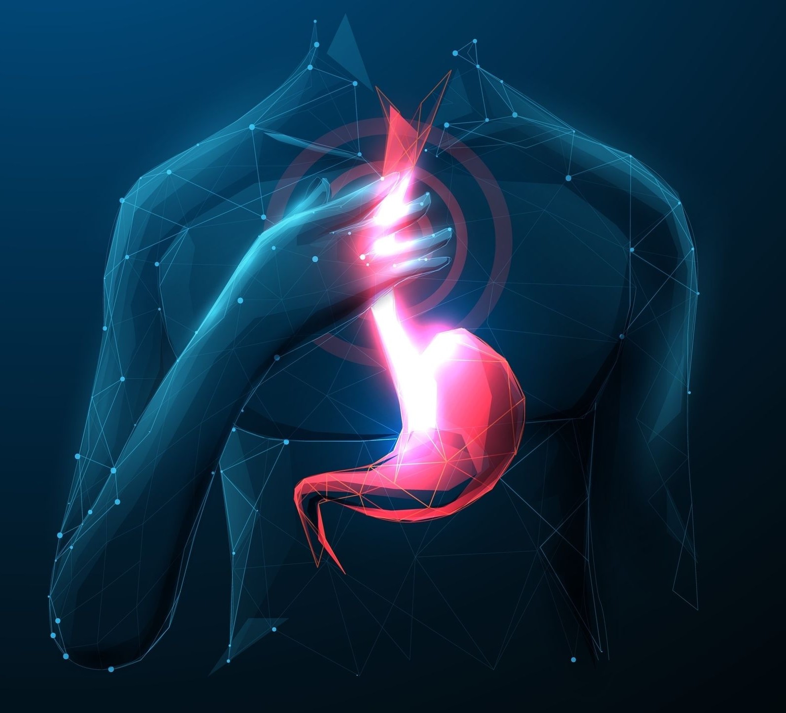 Gastroesophageal Reflux Disease LexiMed