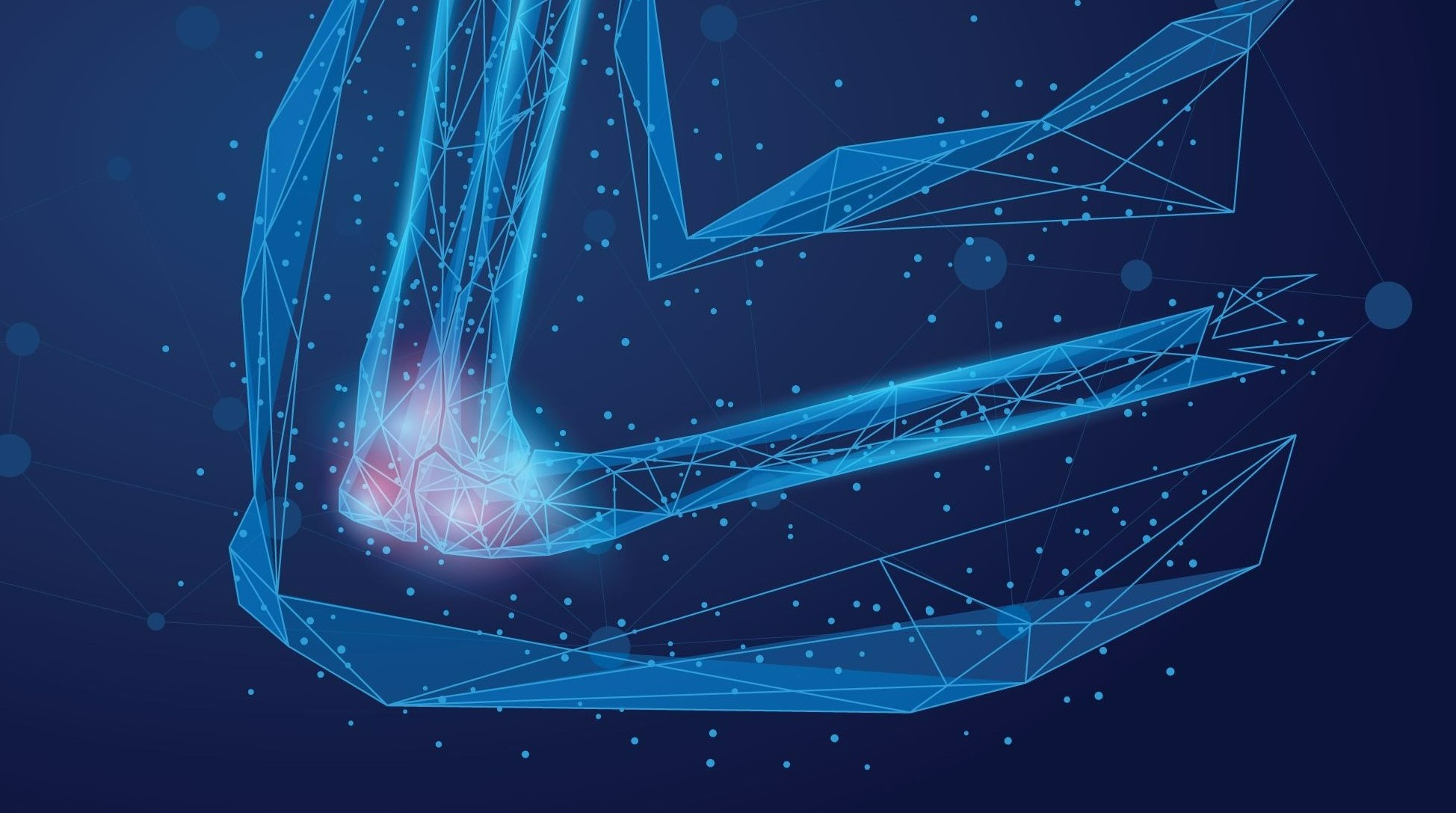 Lateral Epicondylitis LexiMed