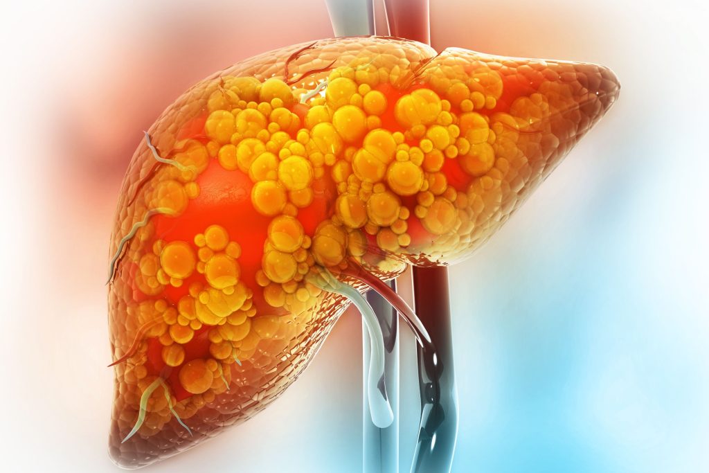 Fatty Liver Image