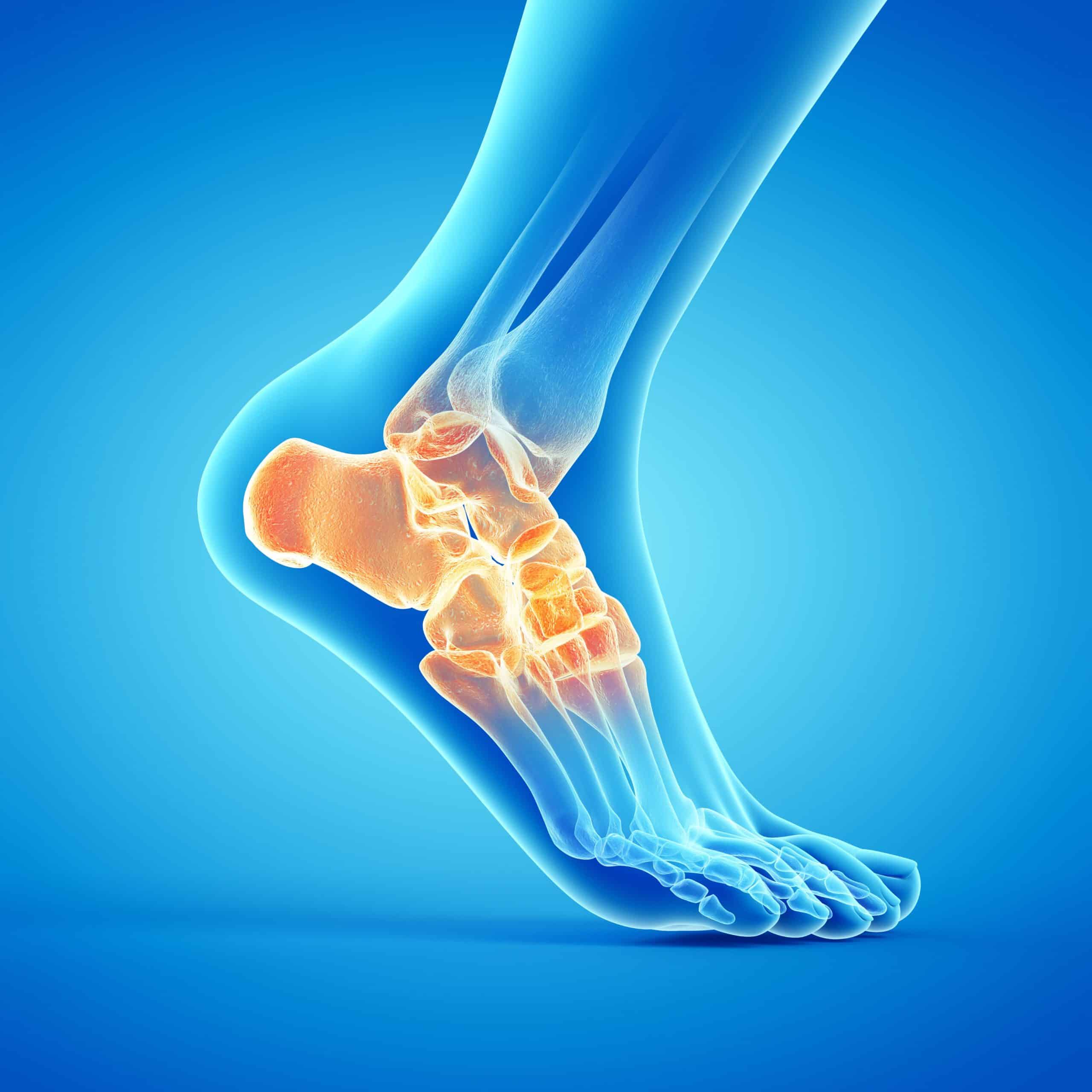 3D x-ray illustration of ankle joint injury assessed through medicolegal expert report