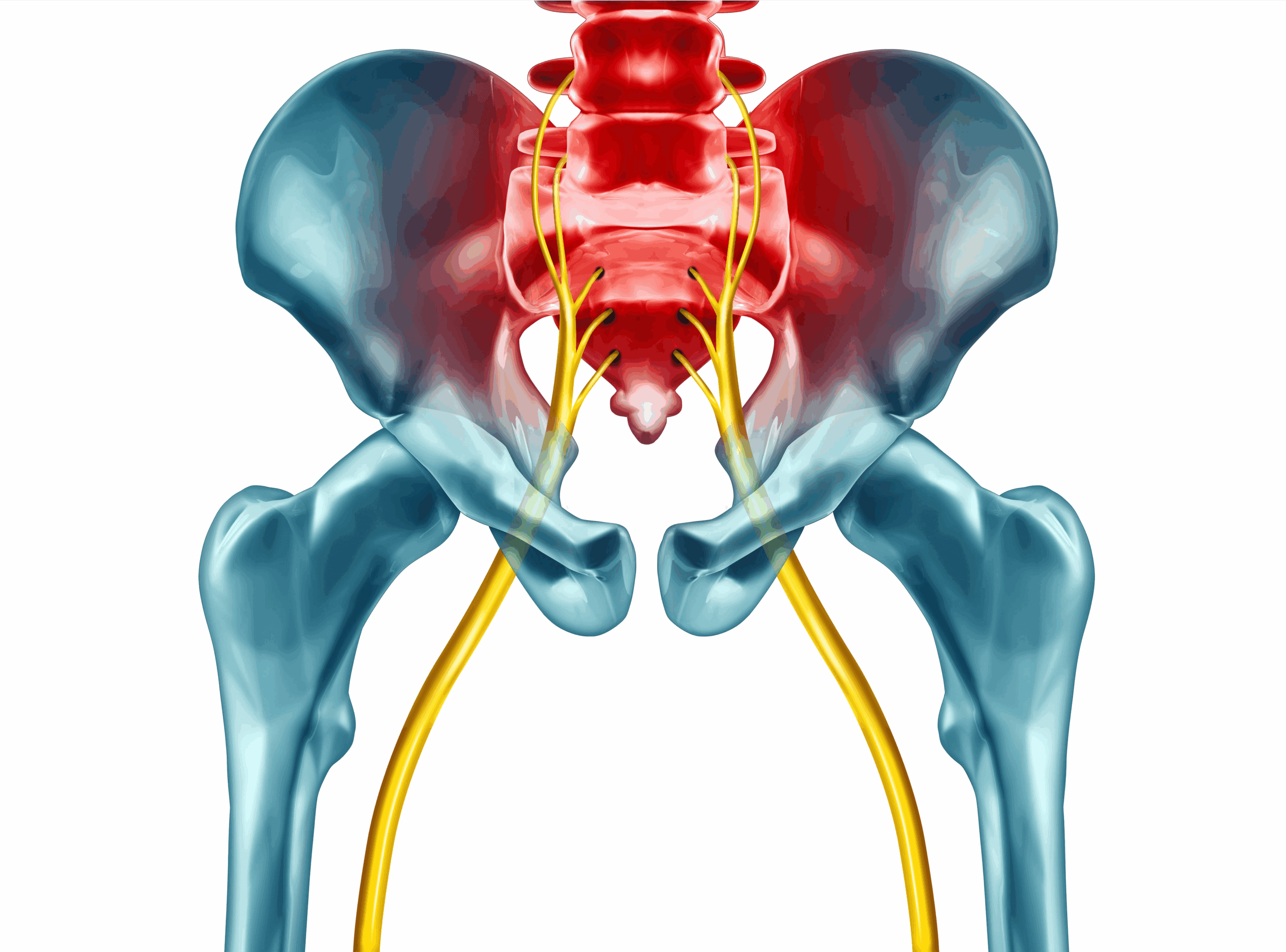 Sciatica Image